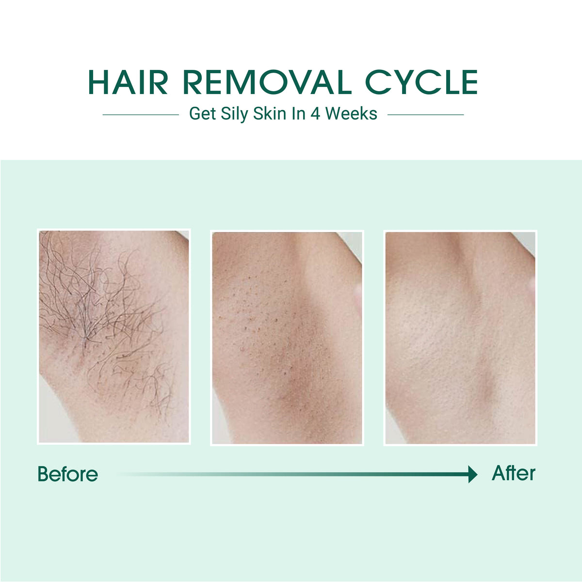 Laser IPL Hair Removal - product photo 4